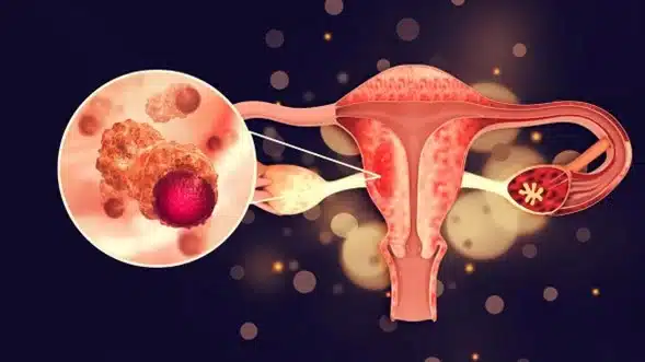 endometriosis