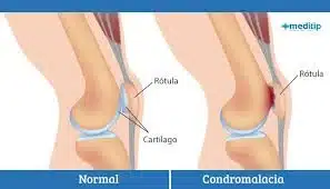 Condromalacia rotuliana