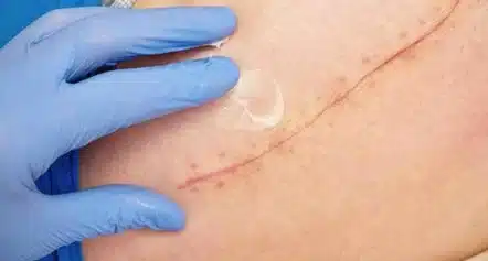 fisioterapia dermatofuncional