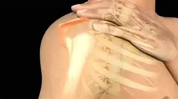ONDAS DE CHOQUE EN TENDINITIS CALCIFICADAS
