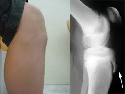 Osgood Schlatter