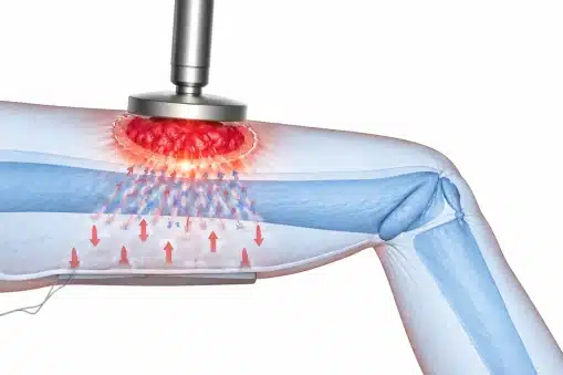 Tecarterapia en fisioterapia